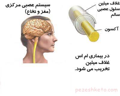 بیماری ام اس