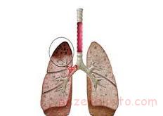معرفی بیماریهای ریه