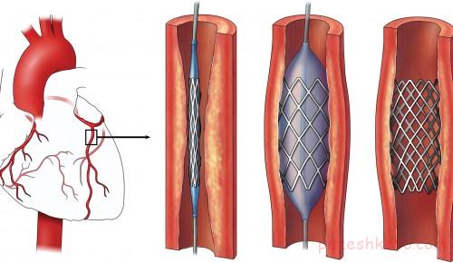 انواع بیماری قلبی
