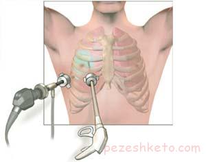 تشخیص سرطان ریه