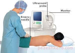 درباره بیوپسی کلیه