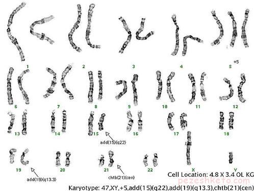 بیماری تای ساکس چیست