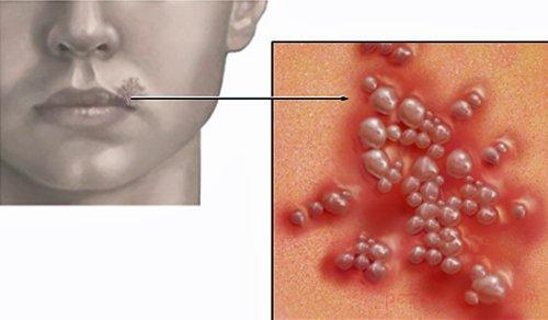 تبخال تناسلی چیست