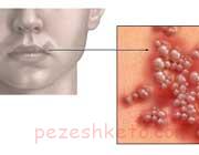 تبخال در کودکان