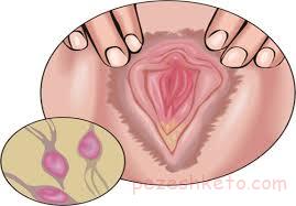 ترشحات خطرناک زنانه