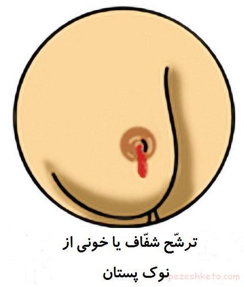 ترشحات سینه