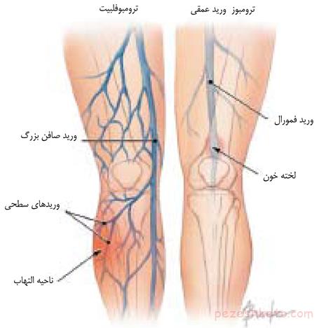 ترومبوز وریدی عمقی