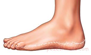 اطلاعاتی درباره ترک پا