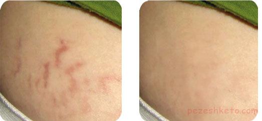 استریا یا خطوط پوستی