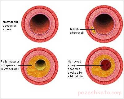 مقاله درباره آترواسکلروز یا تصلب شرائین