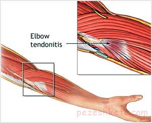 تنوسينوويت