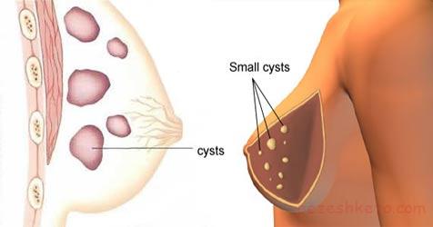 تودهای خوش خیم پستان چیست
