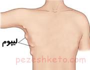 توده چربی زیر پوست