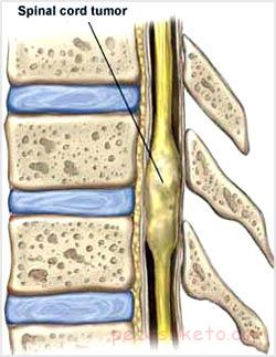 تومور طناب نخاعی