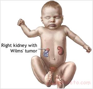 مقاله درباره تومور ویلمز