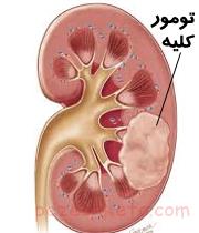 تومور ویلمز