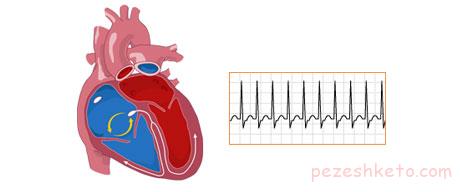 علل ایجاد تپش قلب