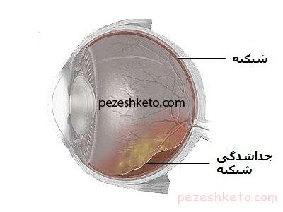 جدا شدگی شبکیه