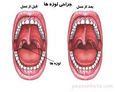 کودکانی که باید جراحی لوزه شوند