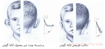 نکاتی در جراحی زیبایی گوش