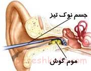 جرم گوش چیست