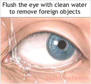 جسم خارجی در چشم