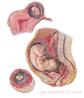 حاملگی خارج از رحم