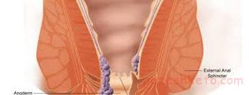 بیماری خارش مقعد