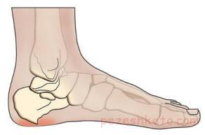 خار پاشنه چیست