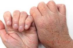 جلوگیری از خشکی پوست