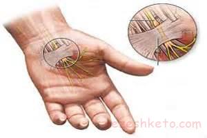 علل خواب رفتن دست و پا