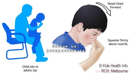 خون دماغ شدن دلایل خون دماغ شدن