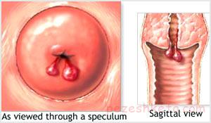 دلایل خونریزی رحم