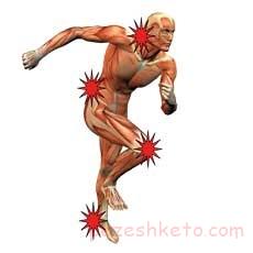 سندرم درد عضلانی