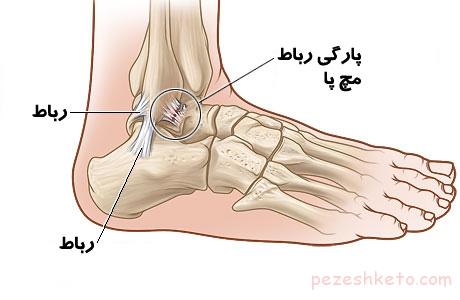 درد مچ پا