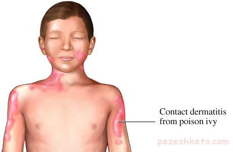 درماتیت یا دانه های ریز روی پوست