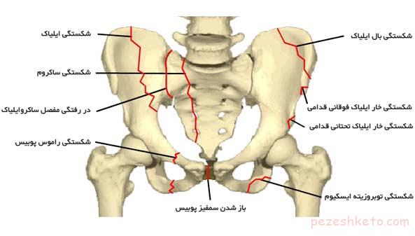 درمان شکستگی استرسی