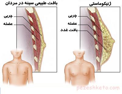 ژنیکوماستی