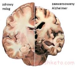 دمانس یا زوال عقل