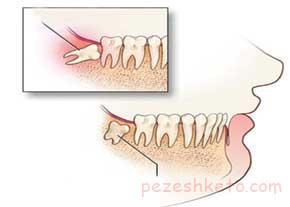 آیا دندان عقل را می توان عصب کشی کرد