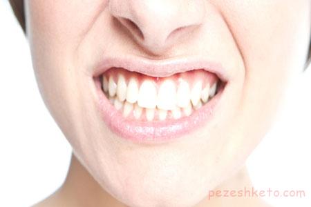 علل دندان قروچه