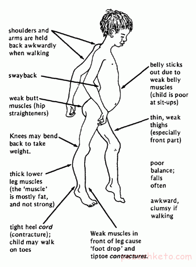 دیستروفی عضلانی