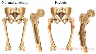 راشیتیسم یا نرمی استخوان چیست