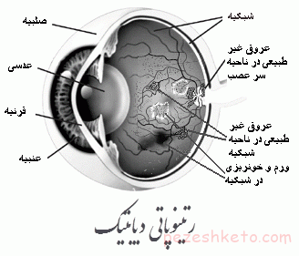 رتینوپاتی دیابتی چیست