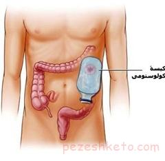 سرطان کولورکتال چیست