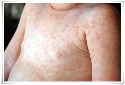 روزئولا چیست