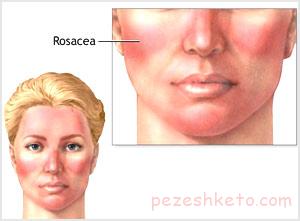 مقاله درباره بیماری روزاسه