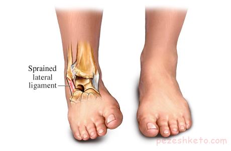 رگ به رگ شدن مفصل چیست