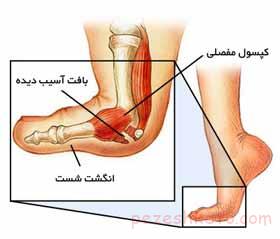 درمان کشیدگی و رگ به رگ شدن شست