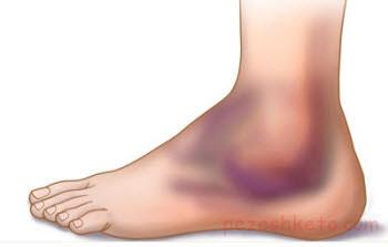 درمان رگ به رگ شدن چیست